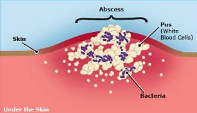 Abscess