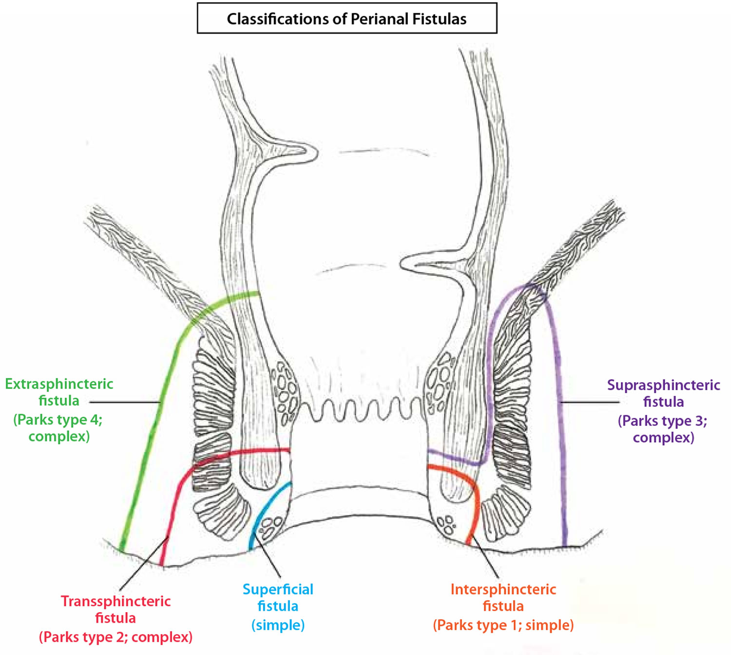 Fistula