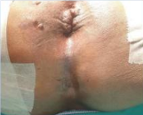 Thrombosed External Haemorrhoid