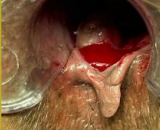Thrombosed External Haemorrhoid