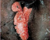 Thrombosed External Haemorrhoid