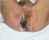 Thrombosed External Haemorrhoid