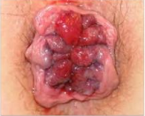 Thrombosed External Haemorrhoid