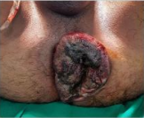 Thrombosed External Haemorrhoid