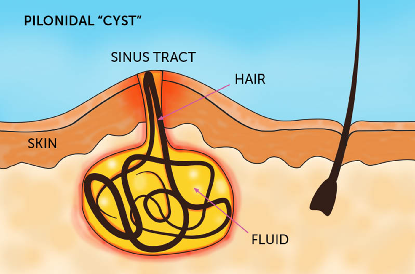 Pilonidal Sinus