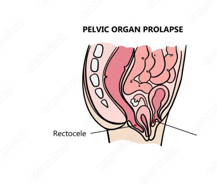 Rectal Prolapse